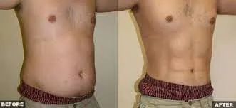 donde se inyecta la lipo c Lipo-Mino-Mix-C  En qu reas del
