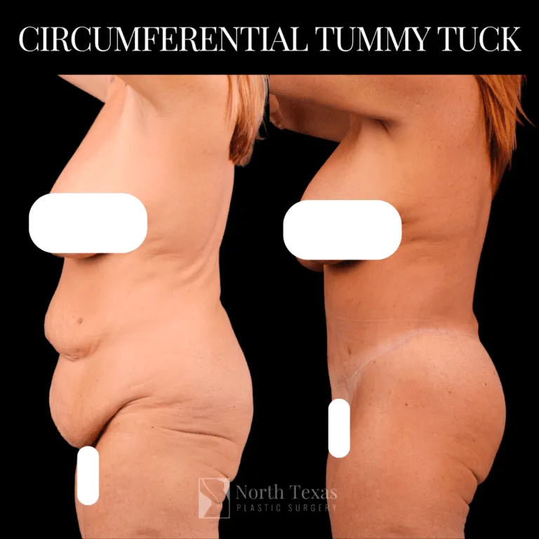 where to inject semaglutide after tummy tuck Tummy Tuck in Dallas | Plano Abdominoplasty
