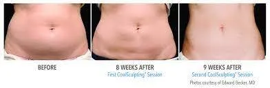 plano north semaglutide Medical Weight Loss TX Semaglutide Weight Loss Shots in