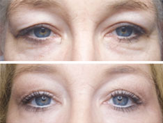 woman's eyes before and after subnovii