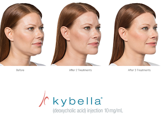 kybella deoxycholic acid injection