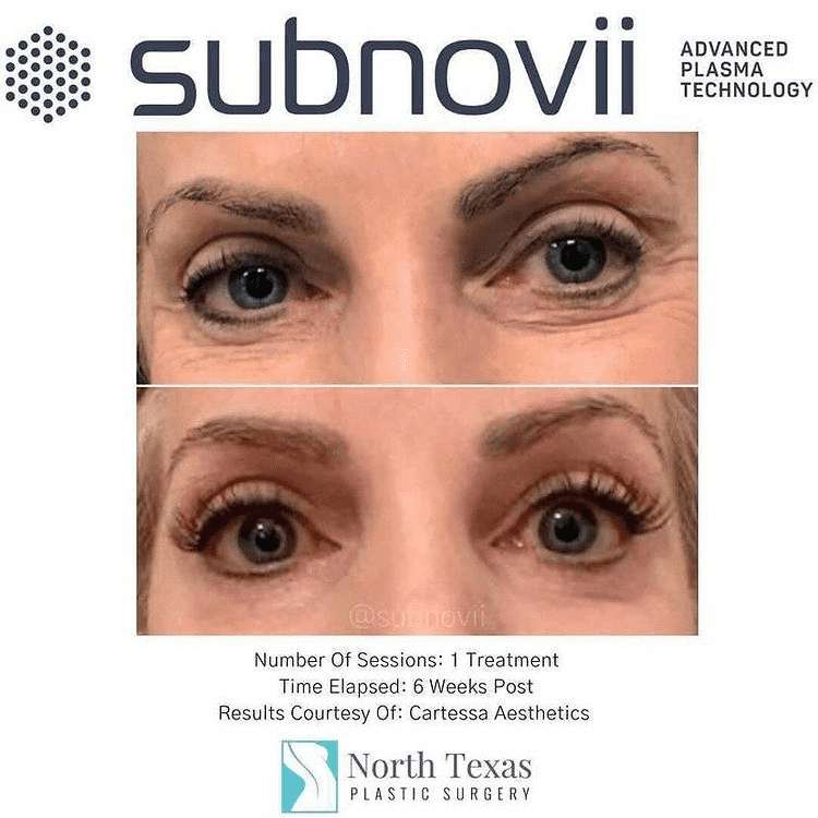 flyer of Subnovii showing woman's eyes before and after treatment