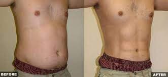 Successful beach body thanks to Liposuction - Fat Removal Surgery in Southlake, Plano, Dallas