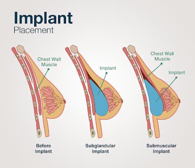 breast implant profile