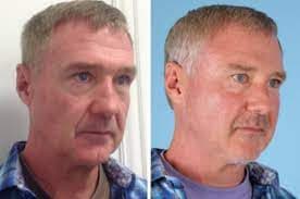 acupulse co2 laser dallas plano texas plastic surgery