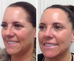 Fully Ablative CO2 Laser Resurfacing Treatment