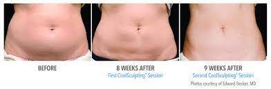 Coolsculpting Before and After Image 2 | Dallas, TX