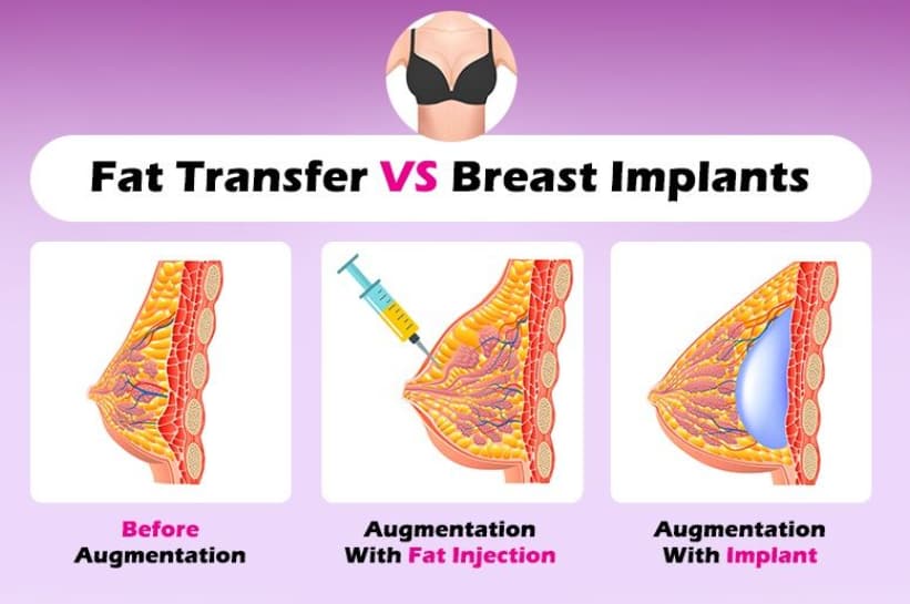 Choosing the right breast implant size - North Texas Plastic Surgery