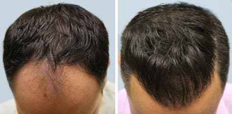 ARTAS hair loss treatment before and after pictures
