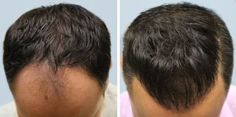 Tratamiento para la caída del cabello ARTAS: fotos de antes y después