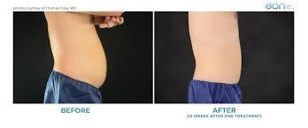 Before and After CoolSculpting | Dallas TX
