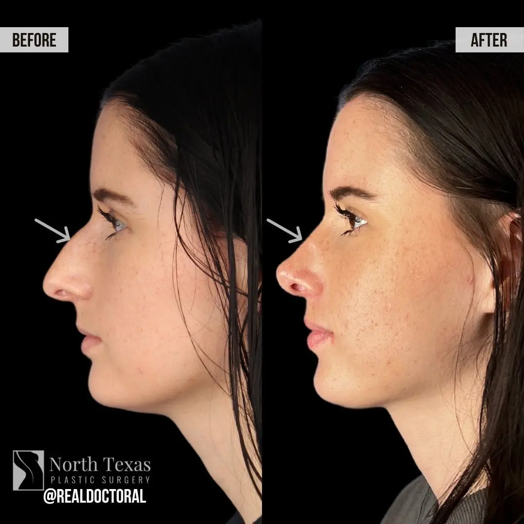 Before and After Rhinoplasty