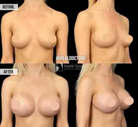 Before and After Breast Augmentation