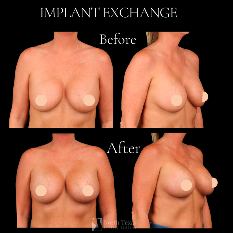 Implant Exchange Patient